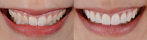 Before and After Dental Photo Before and After Dental Photo