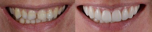 Before and After Dental Photo Before and After Dental Photo