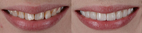 Before and After Dental Photo Before and After Dental Photo